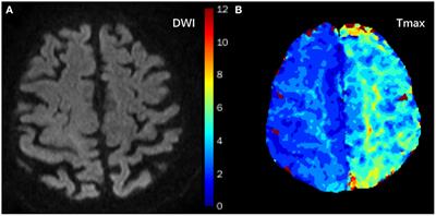 History of Hypertension Is Associated With MR Hypoperfusion in Chinese Inpatients With DWI-Negative TIA